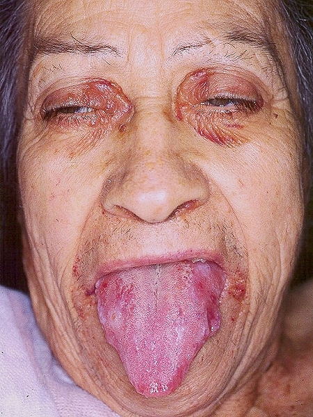 amiloidosis por macroglosia