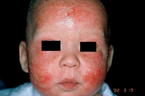 Resultado de imagen para Dermatitis atÃ³pica del lactante